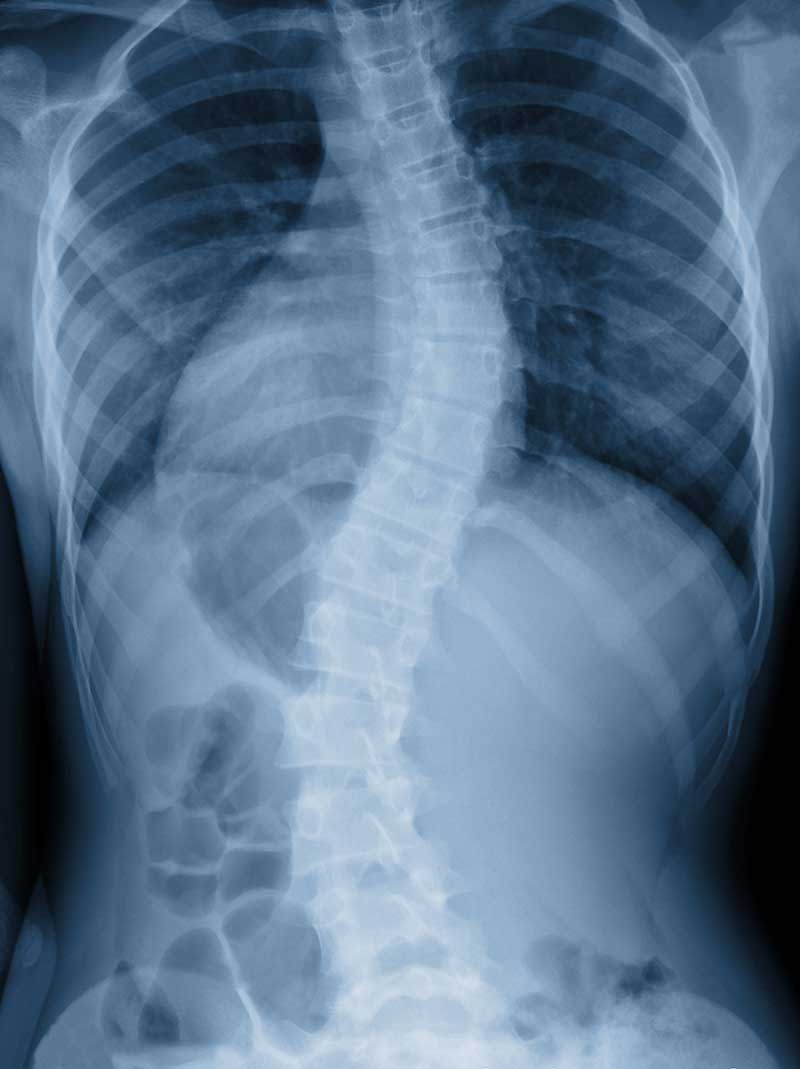 Scoliosis  Richmond, IN 